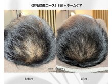 アン ビューティー(ann beauty)の雰囲気（地域初！先進毛髪化学【育毛促進コース】ヒト毛根幹細胞エクソ）