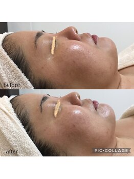 ブリス(Bliss)/肌質改善ハーブトリートメント