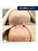 メンズクリア 盛岡店/【メンズクリア】お客様の施術例