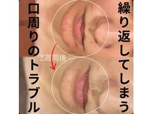 サロンドゥルシエル/繰り返してしまう肌荒れ