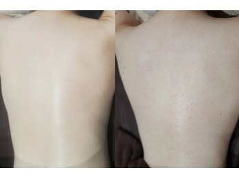 ビーピー 渋谷(b.p.)/背中ハーブピーリング