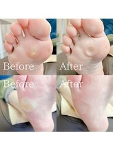あしから/角質、魚の目ケア