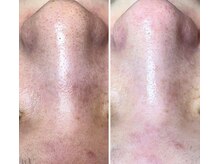 エヌエクラ(N.eclat.)/90分後の毛穴