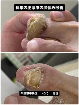 巻き爪じゅん 千葉駅前店/肥厚爪改善！長年の変色にも対応