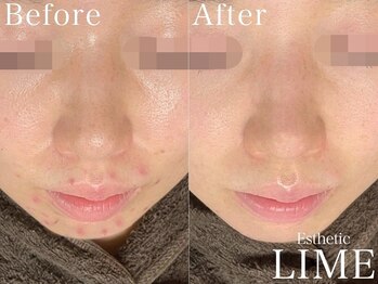 ベル 後楽園 春日(Belle)/オンダリフト｜小顔