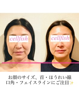 セルフィッシュ(Cellfish)/小顔&全身矯正