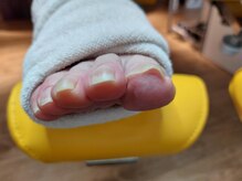 爪切り屋 足楽/巻いた爪のリフト【before】