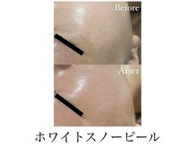 サロンドシェリ(salon de cheri)/ホワイトスノーピール