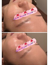 シェノン(Chainon)/毛穴開き・くすみ速攻実感！