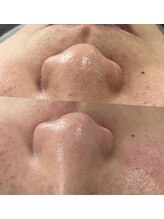 フットミー(foot mii)/毛穴　一回のビフォーアフター