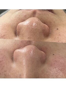 フットミー(foot mii)/毛穴　一回のビフォーアフター