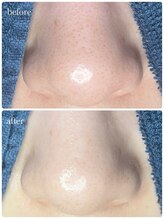 サロン ド ラム/【毛穴×Waxコース】初回の効果