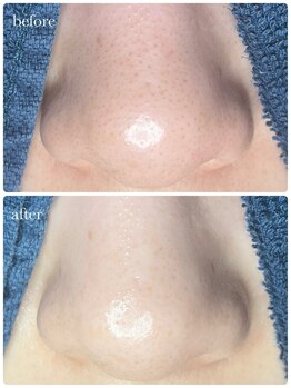 サロン ド ラム/【毛穴×Waxコース】初回の効果