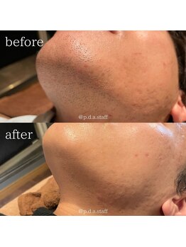 ピーディーエーサロン(PDA salon)/人気メニュー【顔+ヒゲ 脱毛】