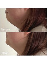 リタ(Rita.)/顎下スッキリ！！