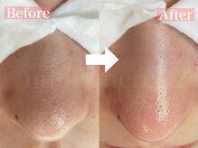 頑固な詰まりも毛穴洗浄でツルツル美肌へ♪JR甲子園口1分