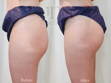 ウナ 西中島店(UNA)/寝ながら筋トレ！電磁パルス