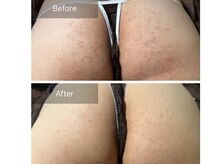 ハーブピーリングでお尻や二の腕・背中もつるつる美肌へ♪