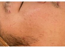 リベル 名古屋(Lebelle:)/ハーブピーリング　栄