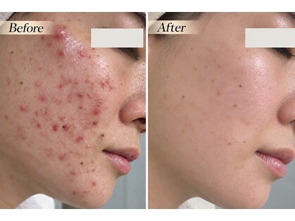 ハクビューティー(HAKU BEAUTY)の写真