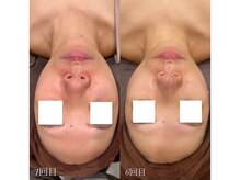 シルク ド ココ(Silk de Coco)/ハーブピーリング+オプション