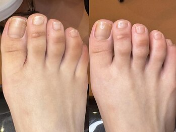 ドクターネイル爪革命 札幌本店の写真/【夏に向けて足裏のがさがさ卒業◎自爪もピカピカに！美容メニューもお任せ！】ひび割れ/匂いの予防も◎
