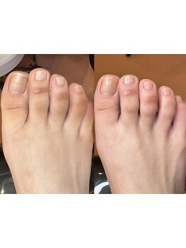 角質ケアができるサロン