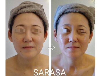 サラサ(SARASA)/大人女子のシワ対策・たるみ対策