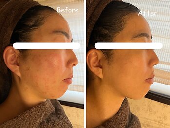 レイ(REI)/◆ニキビケア◆