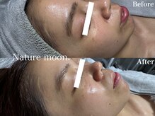 ナチュールムーン(Nature moon.)/ハーブピーリング