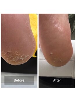 ドクターネイル爪革命 北千住店/角質ケア