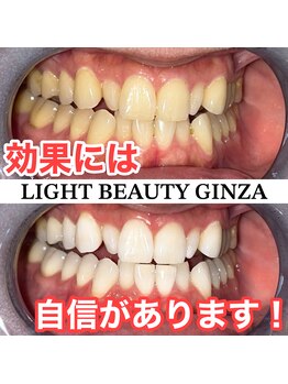 ライトビューティー 銀座店(LightBeauty)/３色LEDマシンでホワイトニング