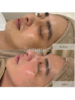 セレニテ(Serenite)/症例写真