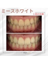 ミースホワイトニング(mys whitening)/ビフォーアフター【歯科提携】