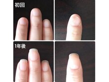 自爪ケア専門サロン イニュラ(inula)/丸い形の爪・凸凹にお悩み