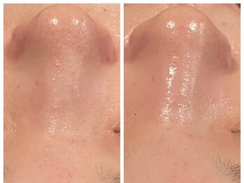 トータルビューティ リライフ(Total beauty Relife)/ハーブ毛穴洗浄