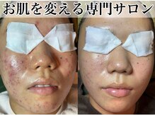 頑固なニキビを原因からケア。肌質改善・優しいピーリング5980円