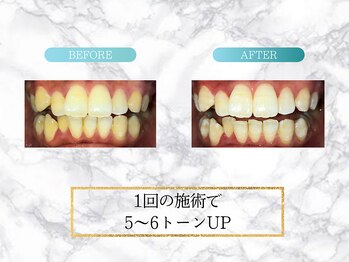 ロイヤル(ROYAL)/【ホワイトニング】before/after