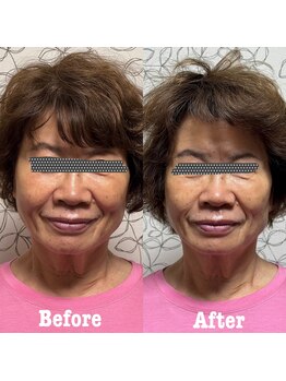 プレシャス(Precious)/EMSで浮腫もスッキリ