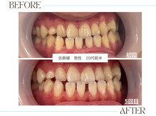 ホワイトニングサロンブライト 尼崎店(Whitening salon bright)/会員様のbefore/after