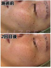 リズベット(LIZ BET)/期間限定!!シミナシキャンペーン