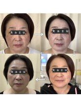 トータルヘルスビューティーカズ(TotalHealthBeauty KAZU)/【肌質改善】光の森/光美容