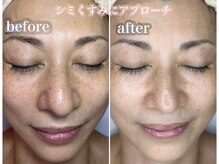 10 ポイント K 目黒(10 POINT. K)の雰囲気（レーザーで取りきれなかったシミにアプローチ！痛みに弱い方も◎）