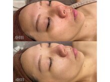 シルク ド ココ(Silk de Coco)/ハーブピーリング+オプション