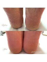 ファレノホワイト/足裏角質除去でツルふわ踵