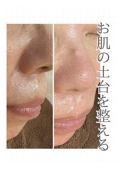 バーグトータルビューティー(bague total beauty)/口周りの産毛が気になる方へ