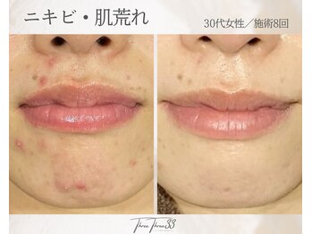 スリースリー(THREE THREE)/ニキビ・肌荒れ