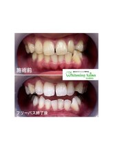 ホワイトニングサロン 名古屋駅店/【ホワイトニング施術例】