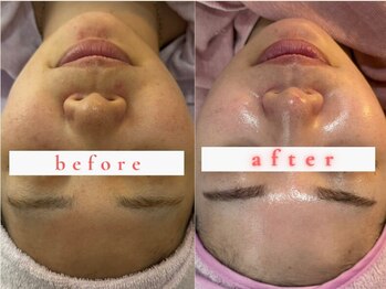 アンベリール(embellir)/タイムロック　2回☆ビフォアフ