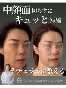 シェリー(Cherie)/中顔面を切らずに短縮する６回